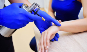 Buang kutil menggunakan cyrosurgery