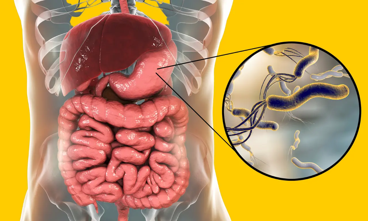 H pylori in stomach lining